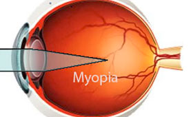 myopia ali kratkovidnost